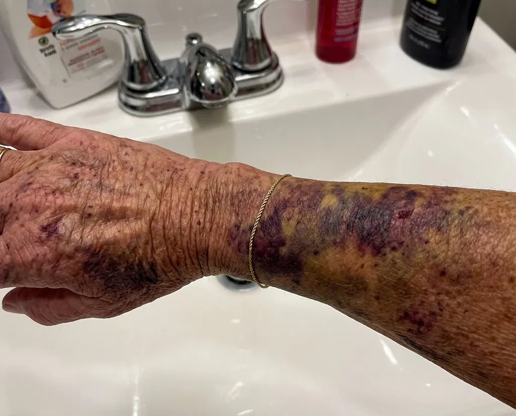 Moretones visibles en un brazo de piel madura